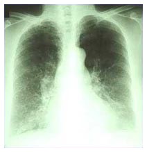 Vaccino: Cancro al polmone