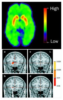 Effetto placebo: individuata l'area neurologica dove ha origine