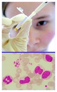 Leucemia mieloide cronica: dasatinib