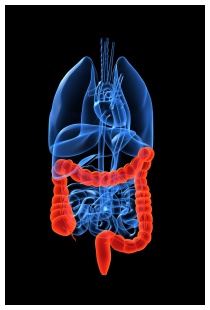 Tumore al colon retto con metastasi al fegato