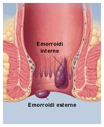 Emorroidi