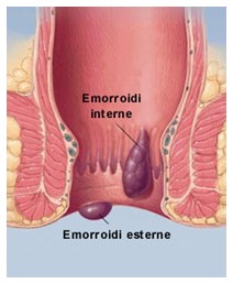 Emorroidi Emorroidi