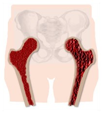 Osteoporosi Osteoporosi