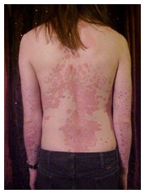 Psoriasi Psoriasi