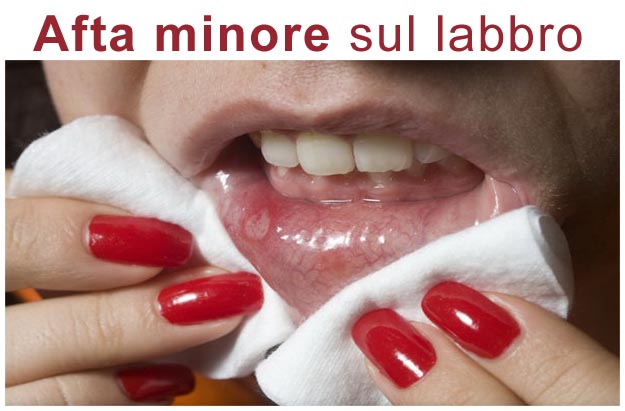 Afte bocca rimedi naturali Afta in bocca