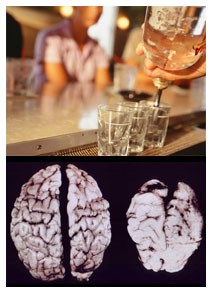 Le bevande alcoliche restringono il cervello Le bevande alcoliche restringono il cervello