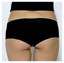 Cellulite e dieta