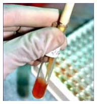 AIDS, diagnosi precoce !