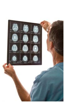 Eccesso di ferro e Alzheimer Eccesso di ferro e Alzheimer