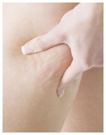 Eliminare la cellulite Eliminare la cellulite