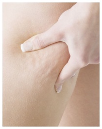 Eliminare la cellulite