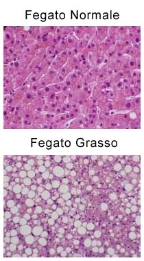 Fegato grasso - steatosi epatica non alcolica Fegato grasso
