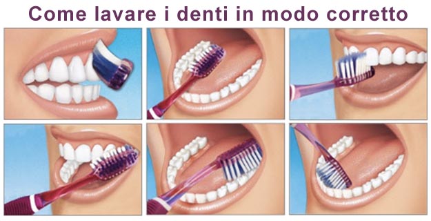 Come lavare i denti in modo corretto Tecnica di spazzolamento di Bass modificata