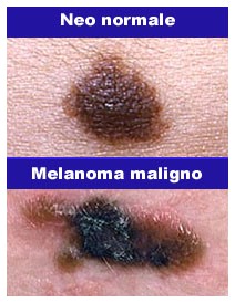 Prevenzione del melanoma: Skin cancer day