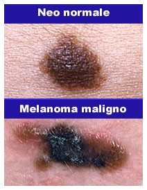 Prevenzione del melanoma: Skin cancer day Prevenzione del melanoma: Skin cancer day