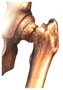 Osteoporosi: il sole fa bene alle ossa Osteoporosi: il sole fa bene alle ossa