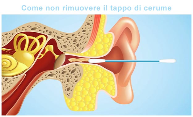 Come non rimuovere il tappo di cerume Tappo di cerume rimedi