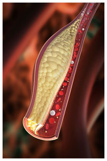 Valori colesterolo:parametri di riferimento per LDL