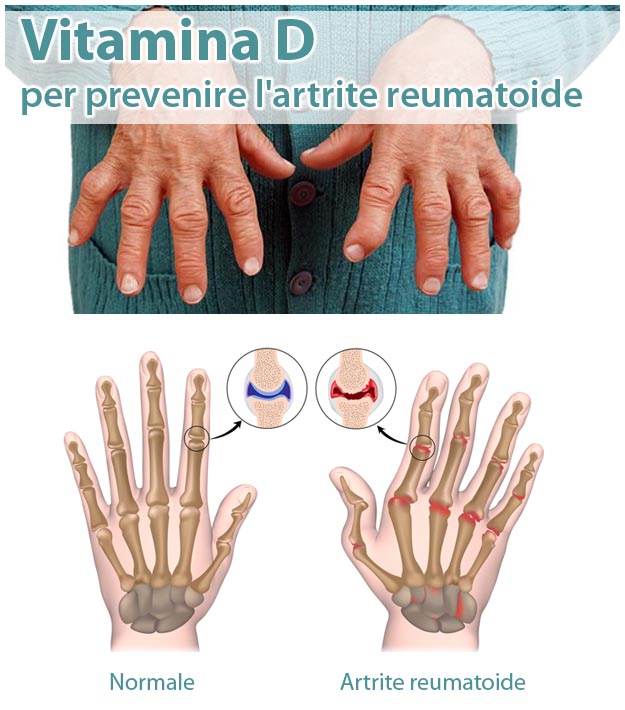 Come Prevenire l'Artrite