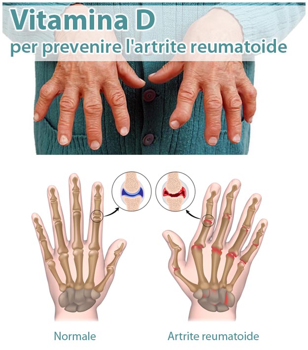 Vitamina D per prevenire l'artrite reumatoide Come Prevenire l'Artrite