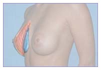 Seno al silicone
