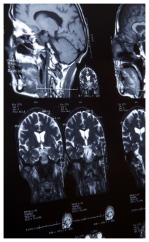 Alzheimer e arginina: cause e cure Alzheimer e arginina: cause e cure