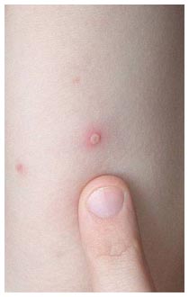 Uno dei sintomi tipici della varicella sono le bolle sulla pelle ettaglio di alcune bolle della varicella