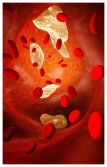 L'aterosclerosi è una malattia vascolare cronica Aterosclerosi