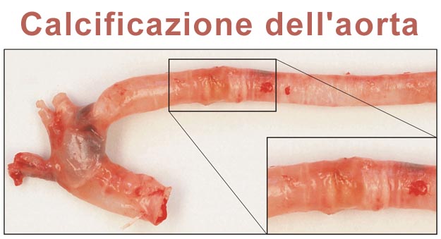 Calcificazione dell'aorta Calcificazione aorta