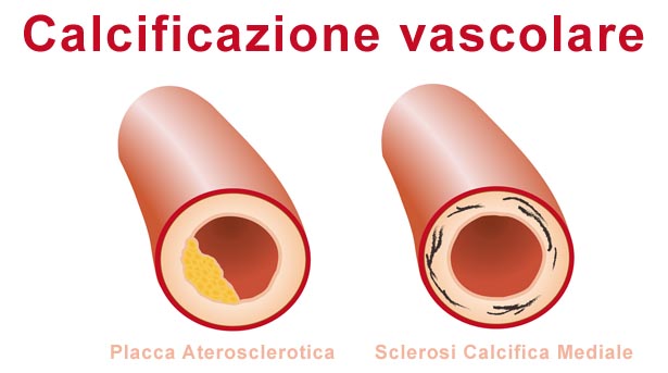 Placca aterosclerotica e sclerosi calcifica mediale Calcificazione vascolare