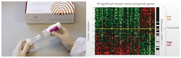 Il MammaPrint indica se si può evitare la chemioterapia MammaPrint test e risultati