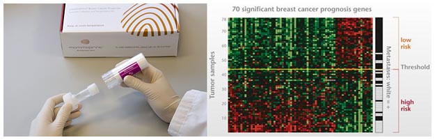 MammaPrint test e risultati