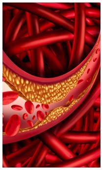 Ipercolesterolemia