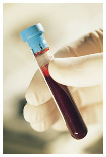 Contagio da HIV e farmaco Truvada
