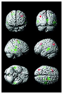 Diagnosi Alzheimer precoce e sostanza bianca