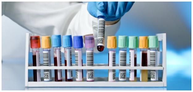 Esame del sangue per identificare il tumore e l'organo interessato Provette con sangue per diagnosi tumore