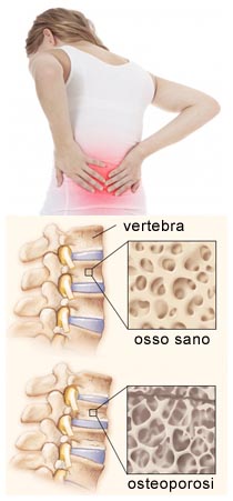 Fratture ossee e Osteoporosi