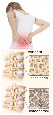 Osteoporosi e Fratture si prevengono con la dieta Fratture ossee e Osteoporosi