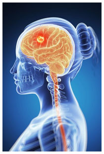 Come il glioblastoma sopravvie ai farmaci antitumorali