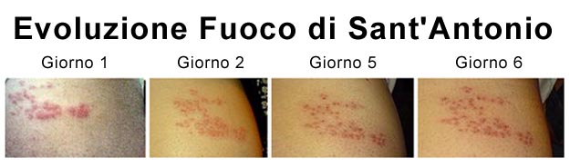 Formazione di nuove lesioni fino a 7 giorni Decorso Fuoco di Sant'Antonio