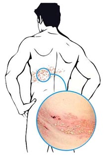 Herpes Zoster o Fuoco di S. Antonio Herpes Zoster
