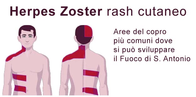 Fuoco di S. Antonio: aree del copro più comuni Rash cutaneo Herpes Zoster