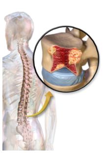 Mieloma multiplo: sintomi (sciatica)