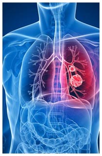 Pembrolizumab per il tumore al polmone in fase avanzata Immunoterapia oncologica polmonare
