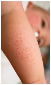 Sintomi setticemia, puntini rossi pelle (petecchie)