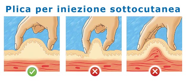 Plica per iniezione sottocutanea Tecnica del pizzico o plica