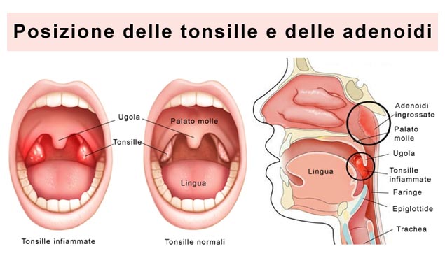Anatomia tonsille e adenoidi