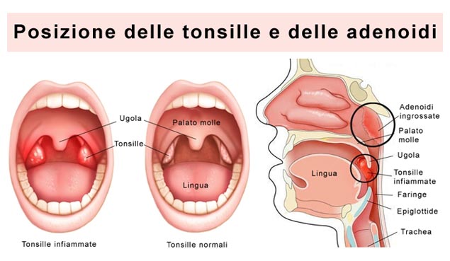 Immagini di tonsille e adenoidi Anatomia tonsille e adenoidi