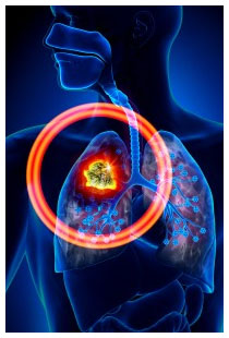 Sopravvivenza tumore polmone