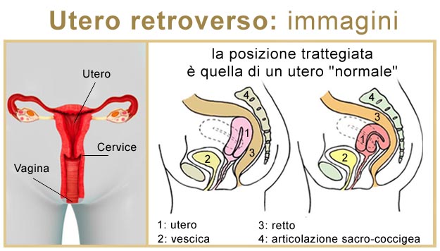 Utero retroverso immagini